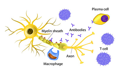 nervous system multiple sclerosis