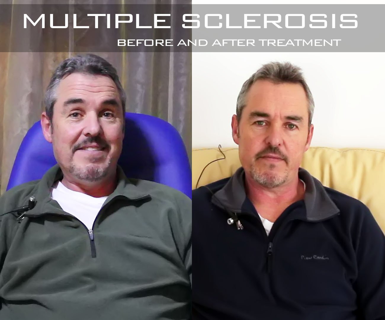 multiple sclerosis treatment before and after