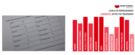 Secondary Progressive multiple sclerosis prognosis