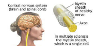 Risk factors of ms patients