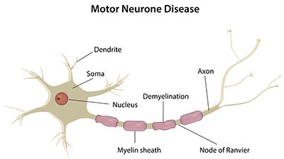 early signs multiple sclerosis