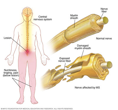 HSCT Nutshell