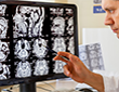 Stem Cells cut new brain lesions in MS