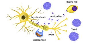 Symptoms of Ms